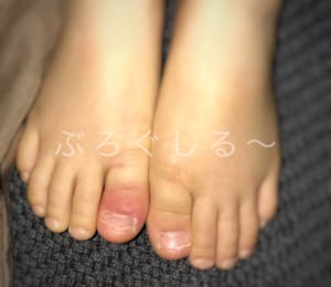 ４歳児の足親指の腫れ